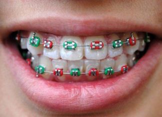 Co trzeba wiedzieć o aparatach ortodontycznych?